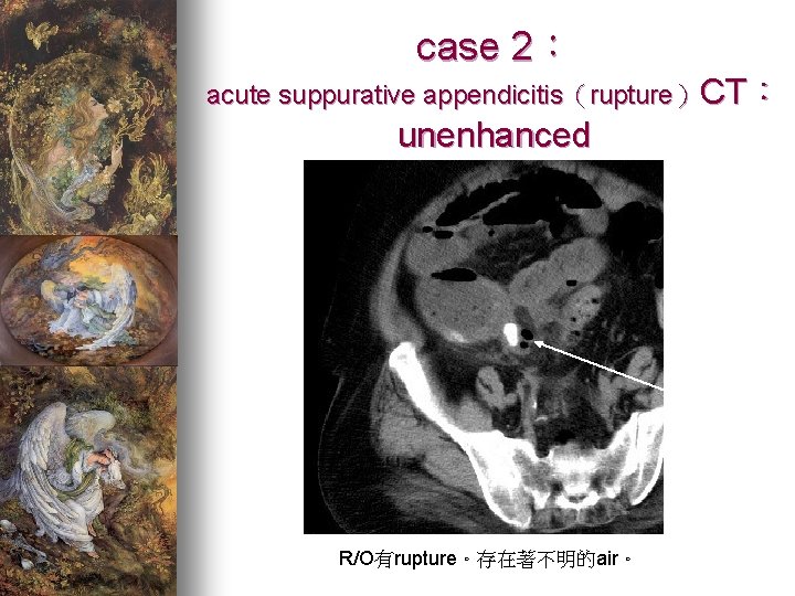 case 2： acute suppurative appendicitis（rupture）CT： unenhanced R/O有rupture。存在著不明的air。 