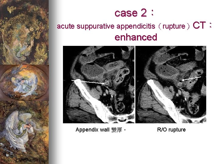 case 2： acute suppurative appendicitis（rupture）CT： enhanced Appendix wall 變厚。 R/O rupture 