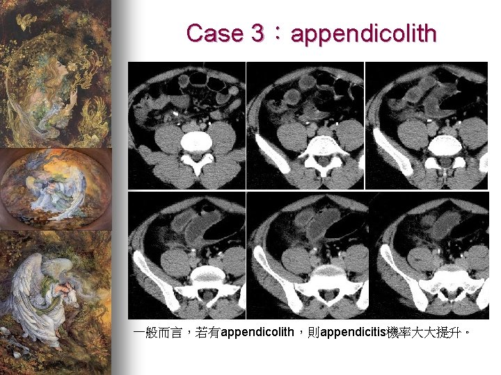 Case 3：appendicolith 一般而言，若有appendicolith，則appendicitis機率大大提升。 