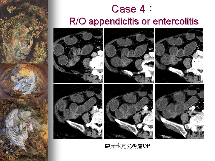 Case 4： R/O appendicitis or entercolitis 臨床也是先考慮OP 