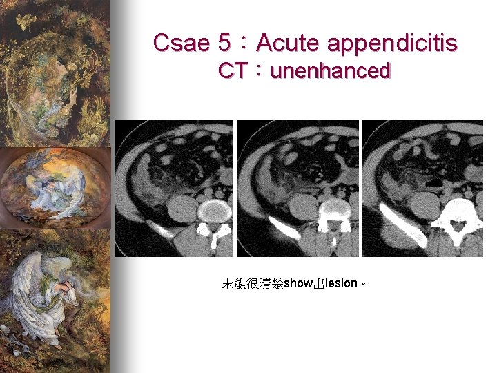 Csae 5：Acute appendicitis CT：unenhanced 未能很清楚show出lesion。 