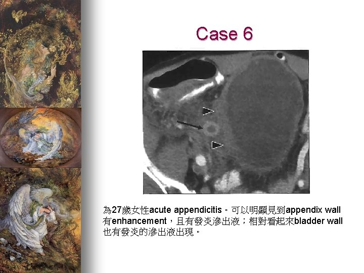 Case 6 為 27歲女性acute appendicitis。可以明顯見到appendix wall 有enhancement，且有發炎滲出液；相對看起來bladder wall 也有發炎的滲出液出現。 