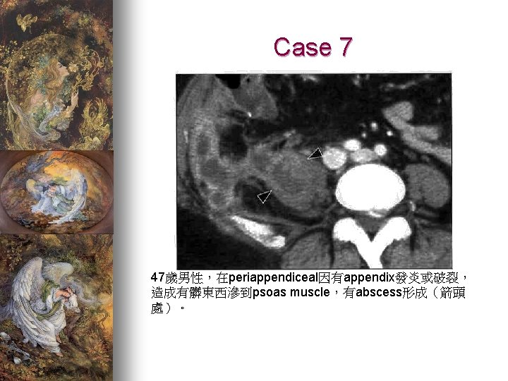 Case 7 47歲男性，在periappendiceal因有appendix發炎或破裂， 造成有髒東西滲到psoas muscle，有abscess形成（箭頭 處）。 