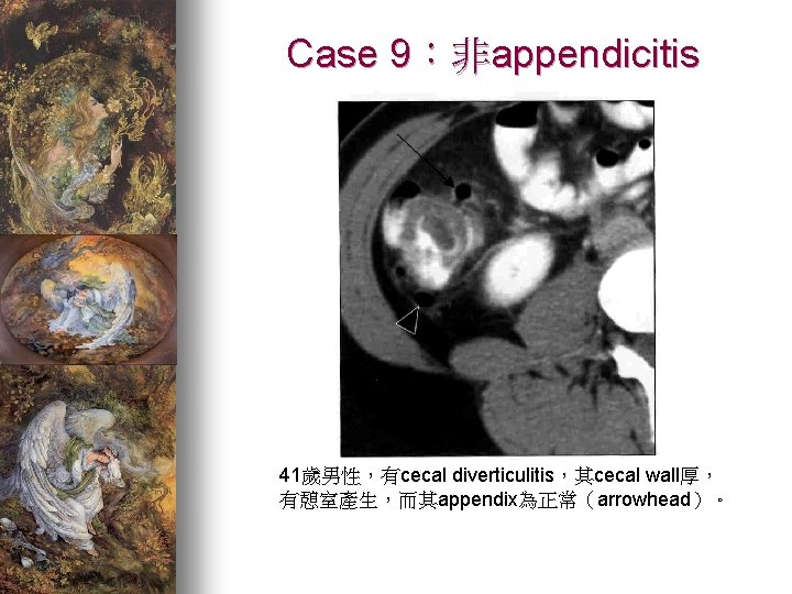 Case 9：非appendicitis 41歲男性，有cecal diverticulitis，其cecal wall厚， 有憩室產生，而其appendix為正常（arrowhead）。 