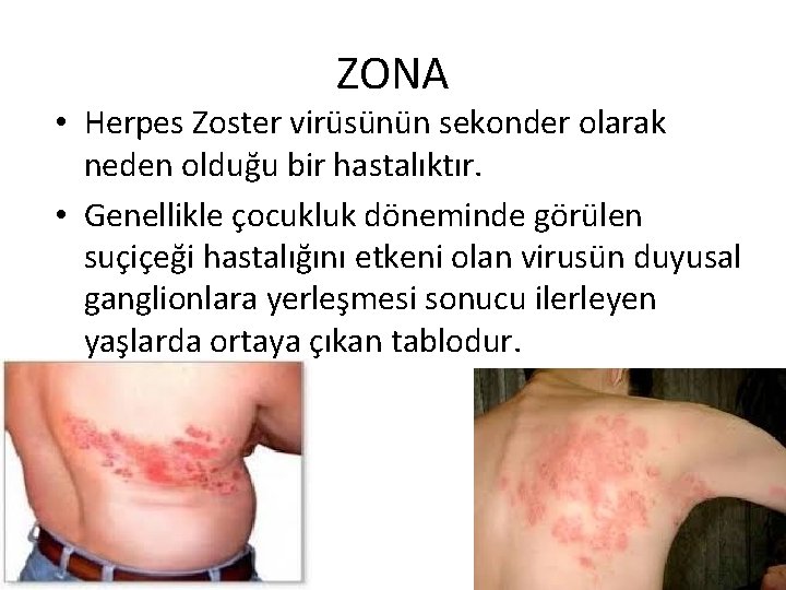 ZONA • Herpes Zoster virüsünün sekonder olarak neden olduğu bir hastalıktır. • Genellikle çocukluk