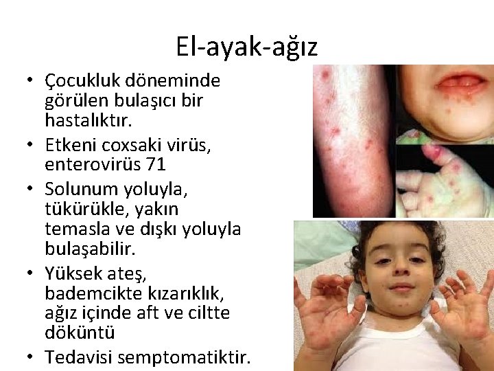 El-ayak-ağız • Çocukluk döneminde görülen bulaşıcı bir hastalıktır. • Etkeni coxsaki virüs, enterovirüs 71