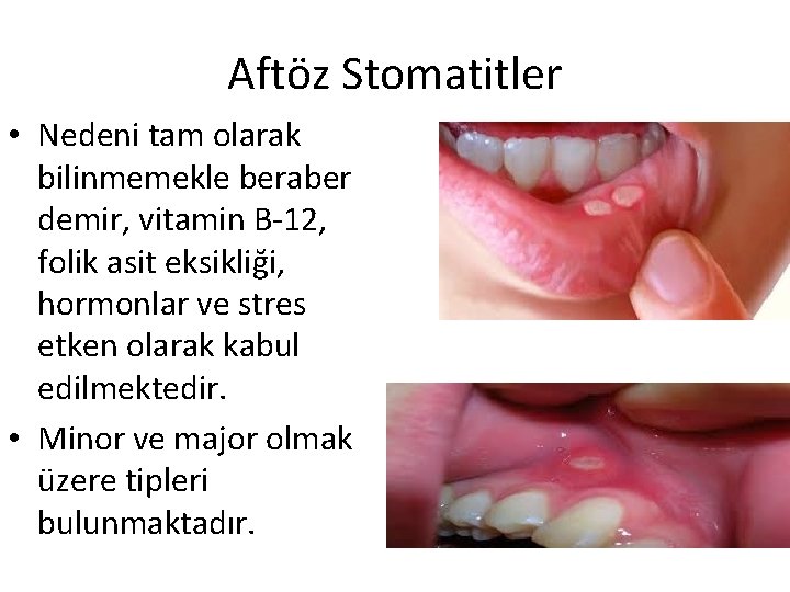 Aftöz Stomatitler • Nedeni tam olarak bilinmemekle beraber demir, vitamin B-12, folik asit eksikliği,