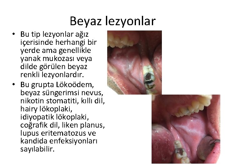 Beyaz lezyonlar • Bu tip lezyonlar ağız içerisinde herhangi bir yerde ama genellikle yanak