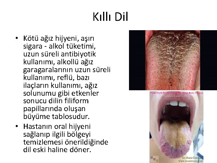 Kıllı Dil • Kötü ağız hijyeni, aşırı sigara - alkol tüketimi, uzun süreli antibiyotik