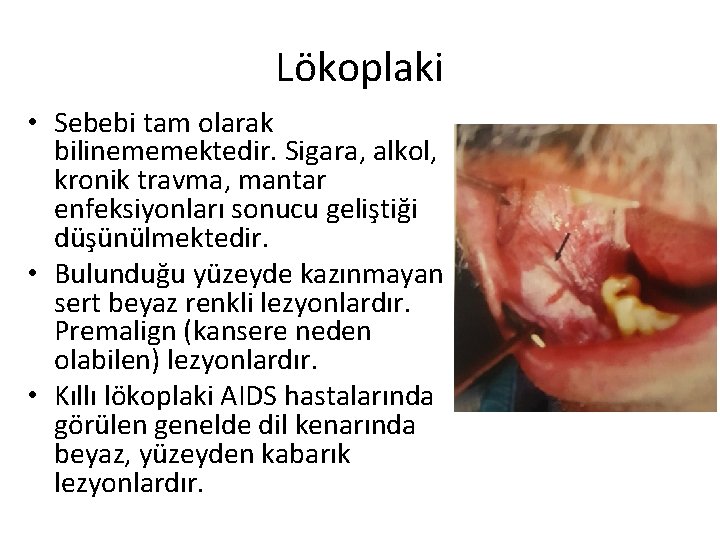 Lökoplaki • Sebebi tam olarak bilinememektedir. Sigara, alkol, kronik travma, mantar enfeksiyonları sonucu geliştiği