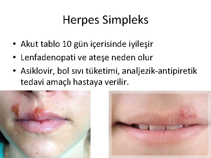 Herpes Simpleks • Akut tablo 10 gün içerisinde iyileşir • Lenfadenopati ve ateşe neden