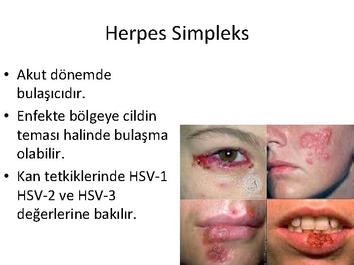 Herpes Simpleks • Akut dönemde bulaşıcıdır. • Enfekte bölgeye cildin teması halinde bulaşma olabilir.