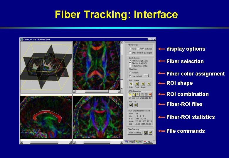 Fiber Tracking: Interface display options Fiber selection Fiber color assignment ROI shape ROI combination Fiber Tracking: Interface display options Fiber selection Fiber color assignment ROI shape ROI combination