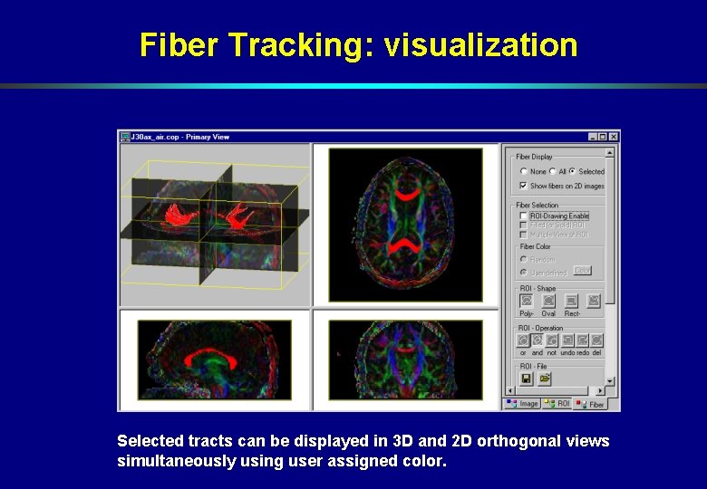 Fiber Tracking: visualization Selected tracts can be displayed in 3 D and 2 D Fiber Tracking: visualization Selected tracts can be displayed in 3 D and 2 D