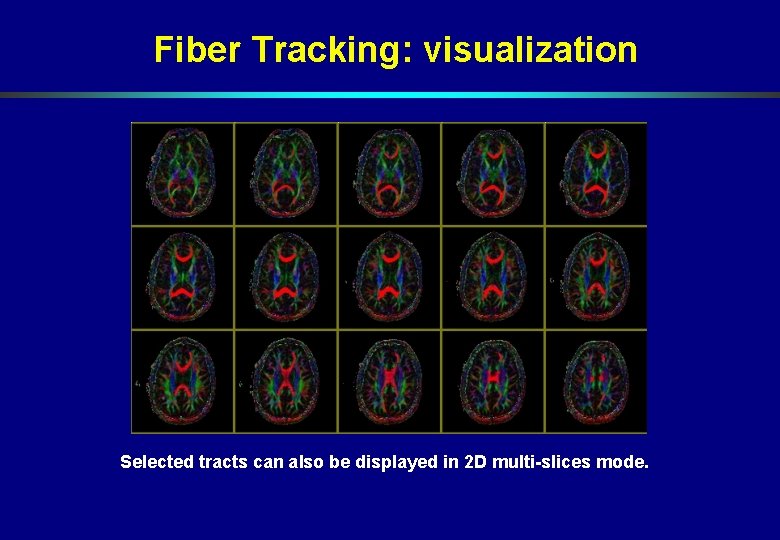 Fiber Tracking: visualization Selected tracts can also be displayed in 2 D multi-slices mode. Fiber Tracking: visualization Selected tracts can also be displayed in 2 D multi-slices mode.
