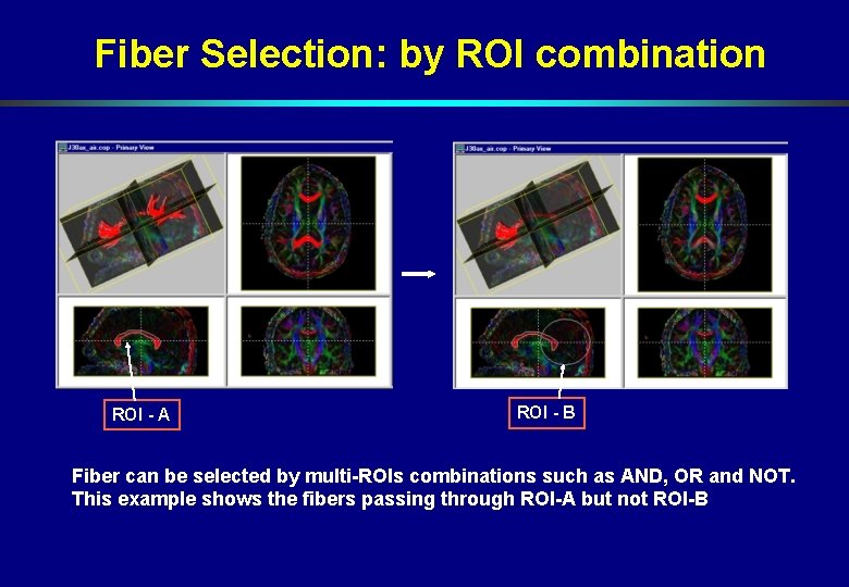 Fiber Selection: by ROI combination ROI - A ROI - B Fiber can be Fiber Selection: by ROI combination ROI - A ROI - B Fiber can be