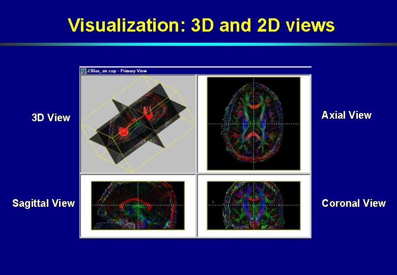 Visualization: 3 D and 2 D views 3 D View Sagittal View Axial View Visualization: 3 D and 2 D views 3 D View Sagittal View Axial View