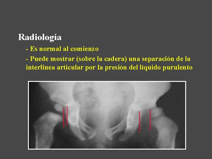 Radiología - Es normal al comienzo - Puede mostrar (sobre la cadera) una separación