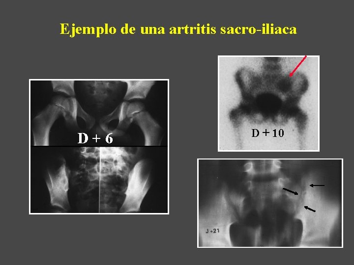 Ejemplo de una artritis sacro-iliaca D+6 D + 10 