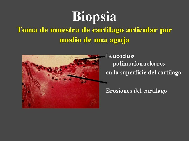 Biopsia Toma de muestra de cartílago articular por medio de una aguja Leucocitos polimorfonucleares