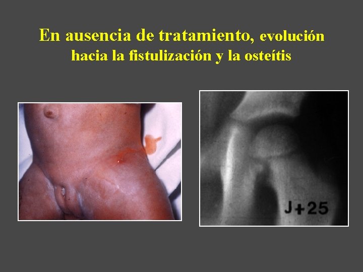 En ausencia de tratamiento, evolución hacia la fistulización y la osteítis 
