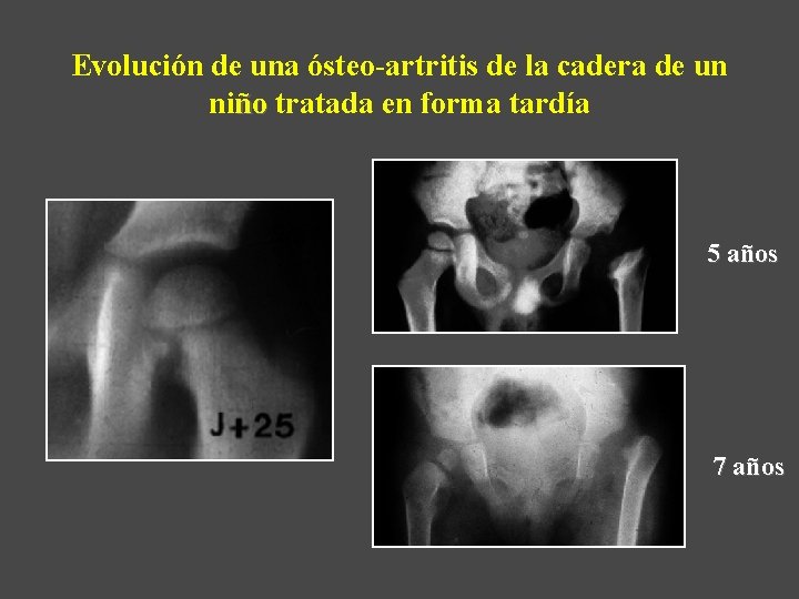 Evolución de una ósteo-artritis de la cadera de un niño tratada en forma tardía