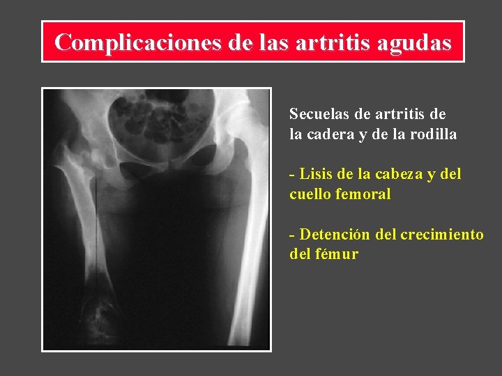 Complicaciones de las artritis agudas Secuelas de artritis de la cadera y de la