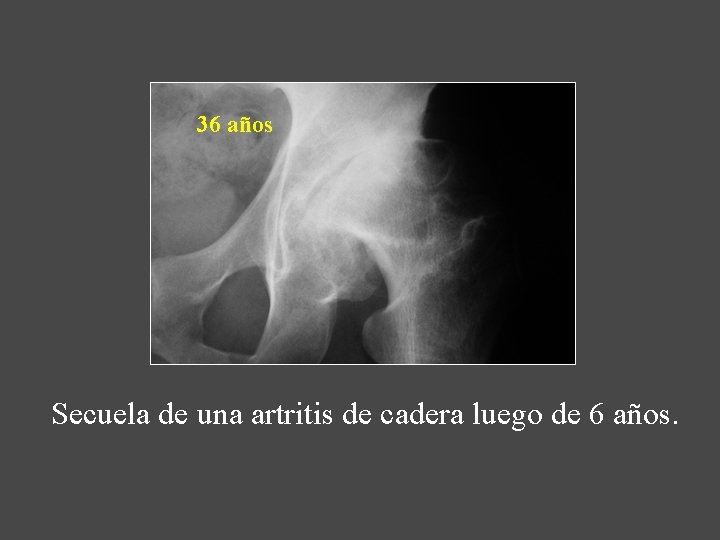 36 años Secuela de una artritis de cadera luego de 6 años. 