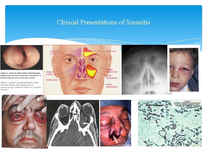 Clinical Presentations of Sinusitis 