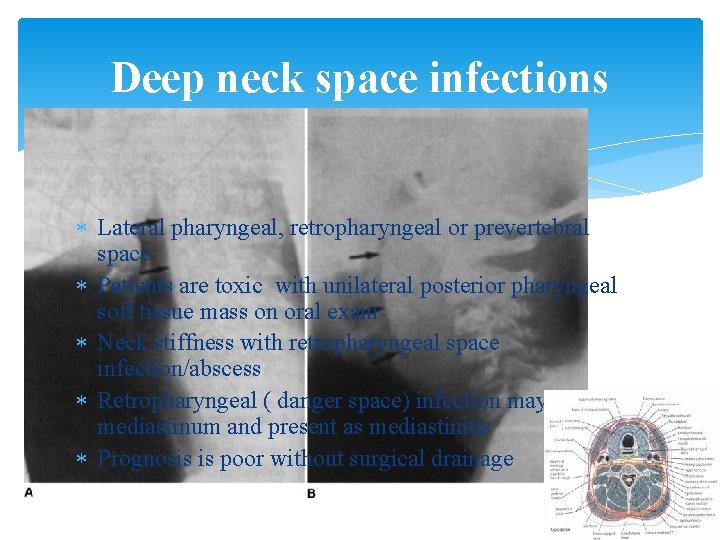 Deep neck space infections Lateral pharyngeal, retropharyngeal or prevertebral space Patients are toxic with