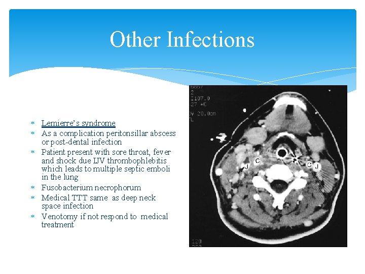 Other Infections Lemierre’s syndrome As a complication peritonsillar abscess or post-dental infection Patient present