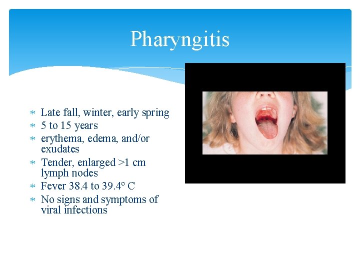 Pharyngitis Late fall, winter, early spring 5 to 15 years erythema, edema, and/or exudates