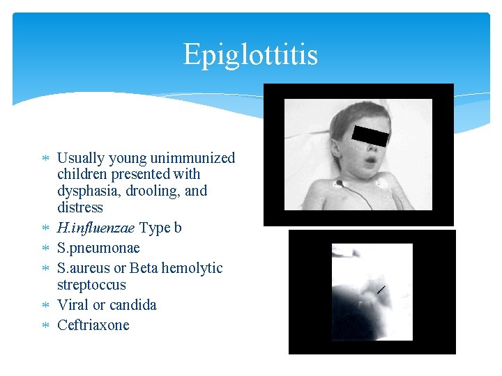 Epiglottitis Usually young unimmunized children presented with dysphasia, drooling, and distress H. influenzae Type