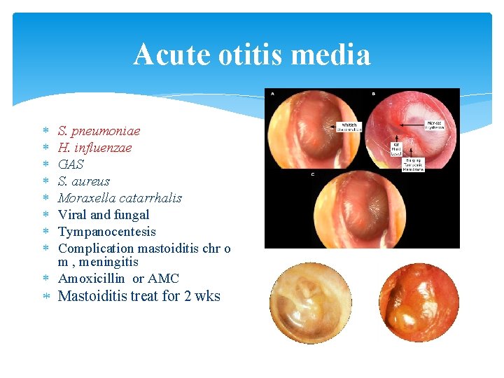 Acute otitis media S. pneumoniae H. influenzae GAS S. aureus Moraxella catarrhalis Viral and