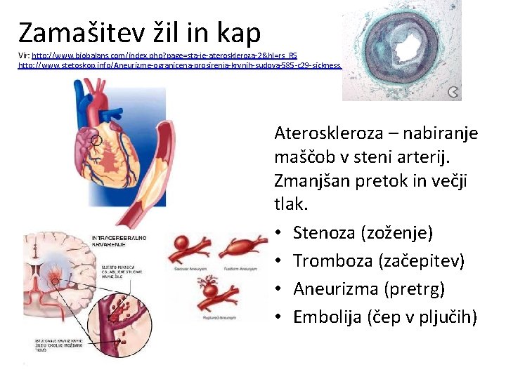 Zamašitev žil in kap Vir: http: //www. biobalans. com/index. php? page=sta-je-ateroskleroza-2&hl=rs_RS http: //www. stetoskop.