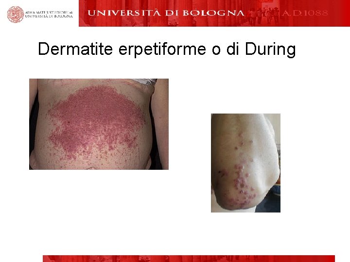 Dermatite erpetiforme o di During 