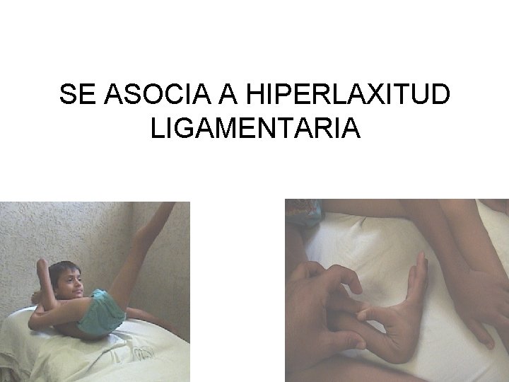 SE ASOCIA A HIPERLAXITUD LIGAMENTARIA 