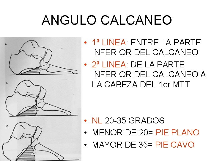 ANGULO CALCANEO • 1ª LINEA: ENTRE LA PARTE INFERIOR DEL CALCANEO • 2ª LINEA: