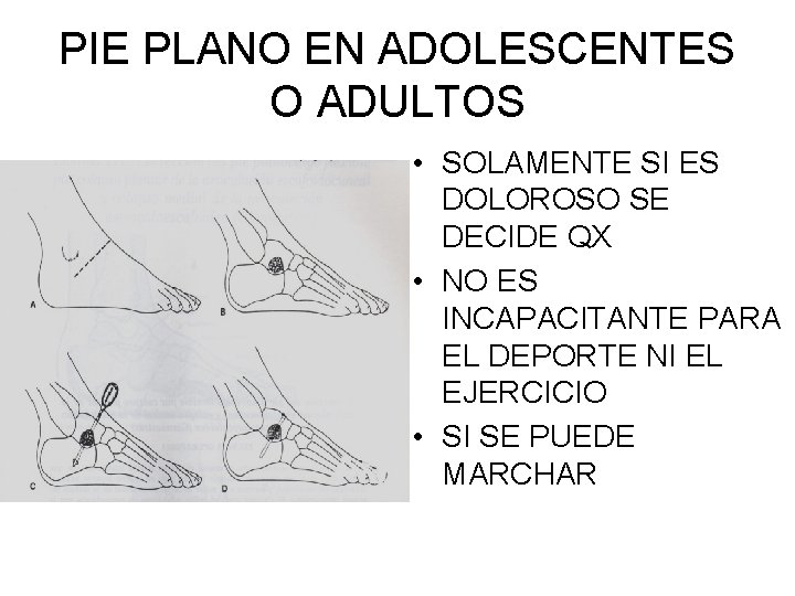 PIE PLANO EN ADOLESCENTES O ADULTOS • SOLAMENTE SI ES DOLOROSO SE DECIDE QX PIE PLANO EN ADOLESCENTES O ADULTOS • SOLAMENTE SI ES DOLOROSO SE DECIDE QX