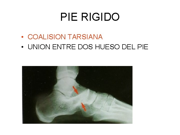 PIE RIGIDO • COALISION TARSIANA • UNION ENTRE DOS HUESO DEL PIE PIE RIGIDO • COALISION TARSIANA • UNION ENTRE DOS HUESO DEL PIE