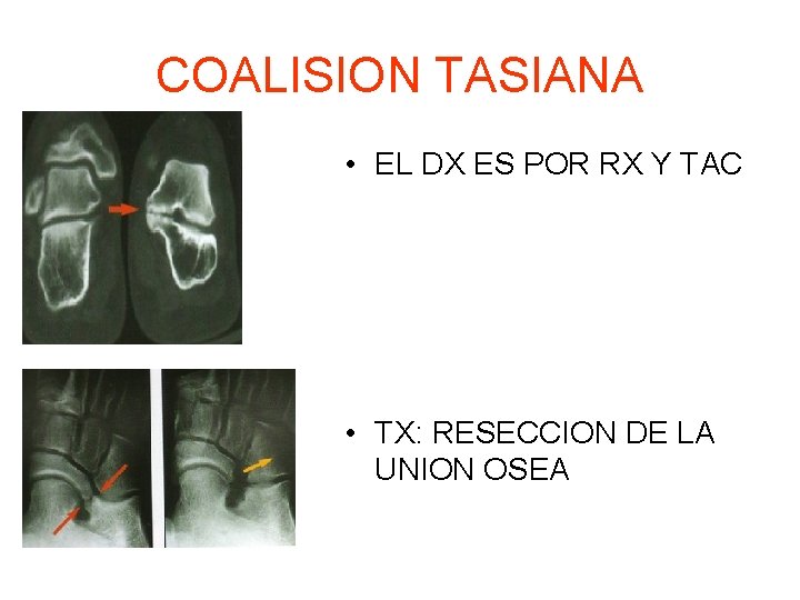 COALISION TASIANA • EL DX ES POR RX Y TAC • TX: RESECCION DE