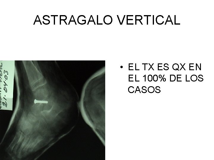 ASTRAGALO VERTICAL • EL TX ES QX EN EL 100% DE LOS CASOS ASTRAGALO VERTICAL • EL TX ES QX EN EL 100% DE LOS CASOS