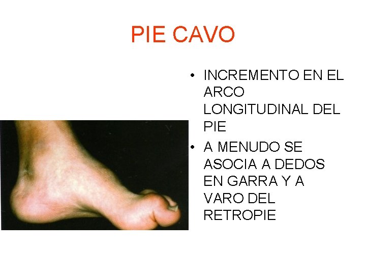 PIE CAVO • INCREMENTO EN EL ARCO LONGITUDINAL DEL PIE • A MENUDO SE