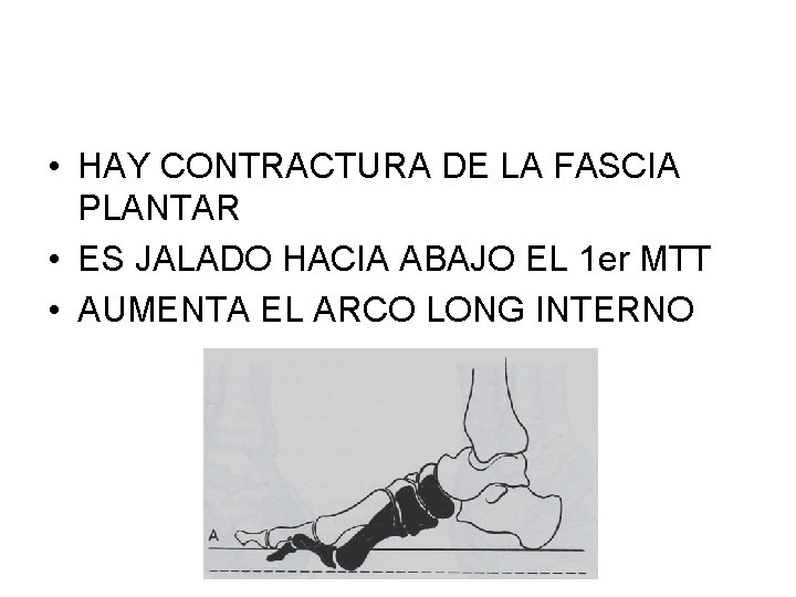  • HAY CONTRACTURA DE LA FASCIA PLANTAR • ES JALADO HACIA ABAJO EL