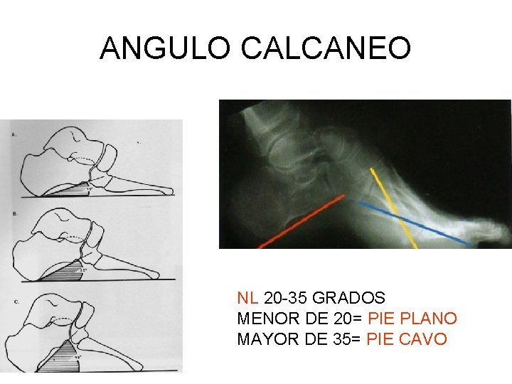 ANGULO CALCANEO NL 20 -35 GRADOS MENOR DE 20= PIE PLANO MAYOR DE 35=