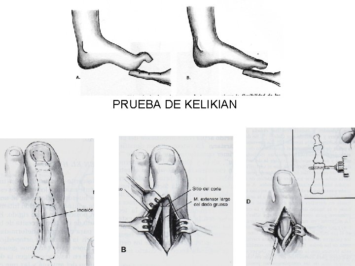 PRUEBA DE KELIKIAN 