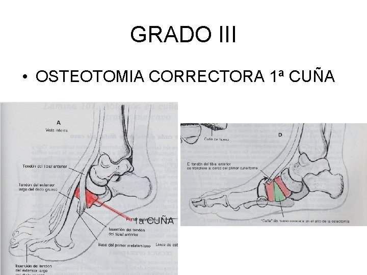 GRADO III • OSTEOTOMIA CORRECTORA 1ª CUÑA 