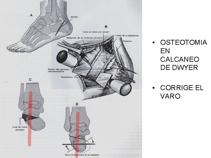  • OSTEOTOMIA EN CALCANEO DE DWYER • CORRIGE EL VARO 