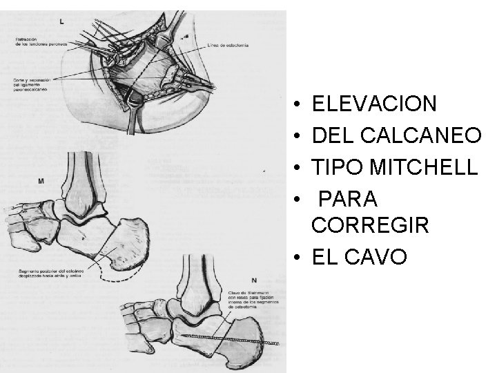  • • ELEVACION DEL CALCANEO TIPO MITCHELL PARA CORREGIR • EL CAVO 