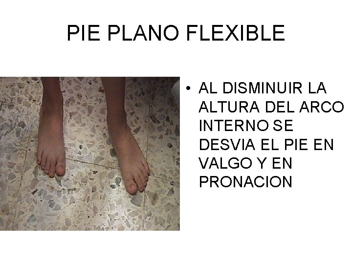 PIE PLANO FLEXIBLE • AL DISMINUIR LA ALTURA DEL ARCO INTERNO SE DESVIA EL